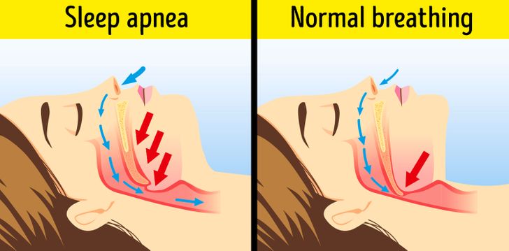 Can You Get Rid Of Sleep Apnea If You Lose Weight What Happens To Your Body When You Lose Extra Weight