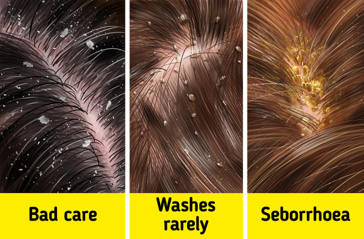 Why Dandruff Appears and How to Effectively Deal With It / Bright Side