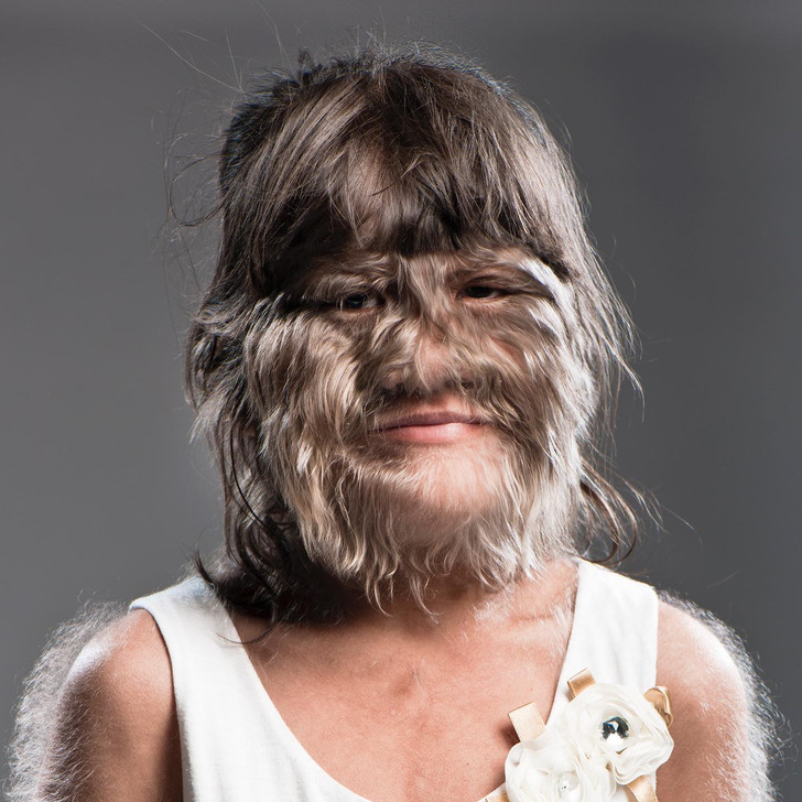 Supatra "Natty" Sasuphan, was once dubbed the world's hairiest girl. A young girl with fur-like facial hair all over her face and arms, smiles in white dress.