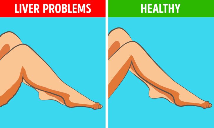 6 Ways Your Legs Can Show You if Something’s Wrong With Your Inner Organs