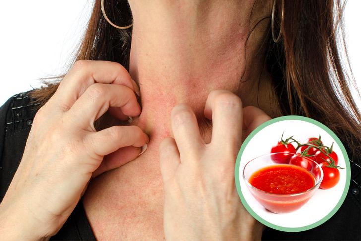 Tomato Allergy Symptoms