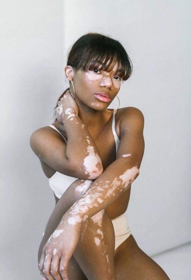 A Photographer With Vitiligo Captures the Beauty of Women With the Same Condition, and It’s a Sight to Behold