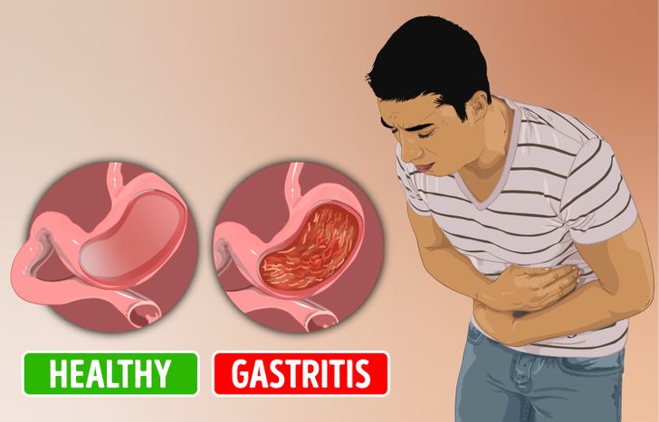 12 Symptoms That Are Rushing to Reveal You Have Gastritis