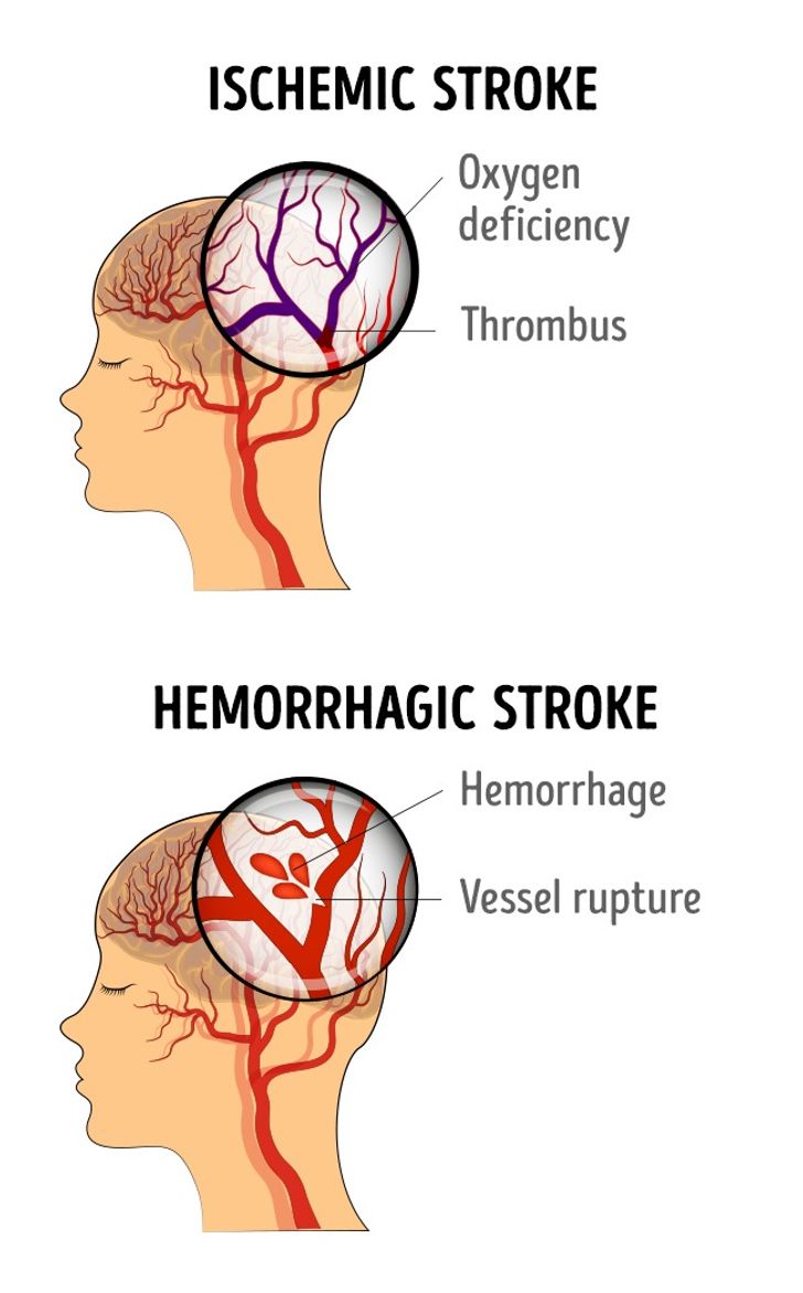 7 Symptoms of Strokes in Women