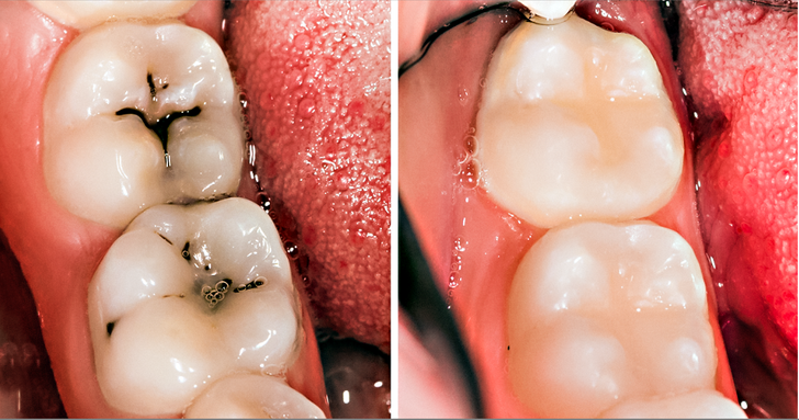 8 Simple Ways to Naturally Reverse Cavities and Heal Tooth Decay