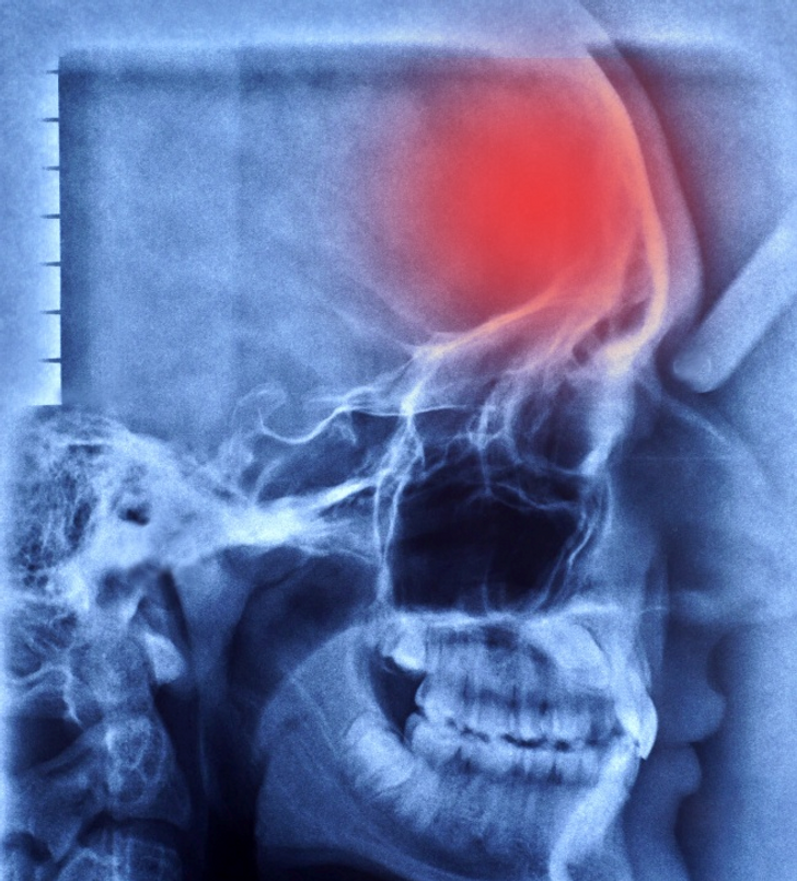 How to Recognize a Stroke and What to Do to Prevent Its Damaging Effects