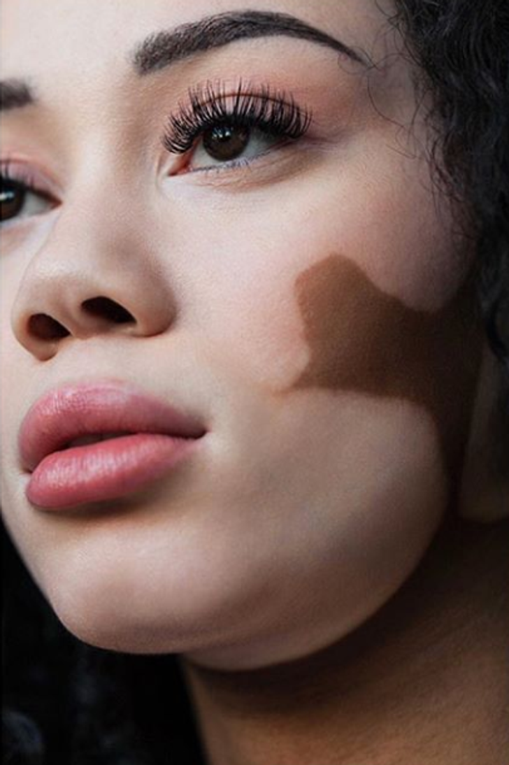 A Photographer With Vitiligo Captures the Beauty of Women With the Same Condition, and It’s a Sight to Behold