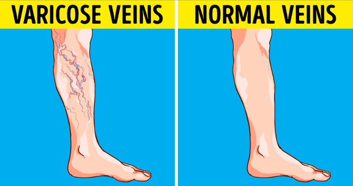 Circulatie defectuoasa la nivelul membrelor inferioare si dureri atroce ale picioarelor