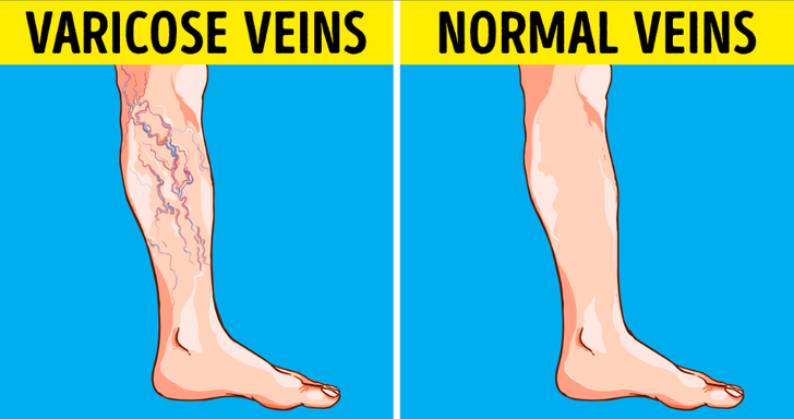 start stage varicose picioare cum de a trata